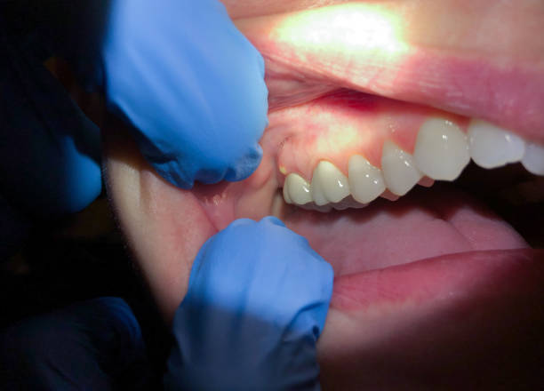 Best Emergency Dental Care for Abscessed Tooth in Woodstock, GA